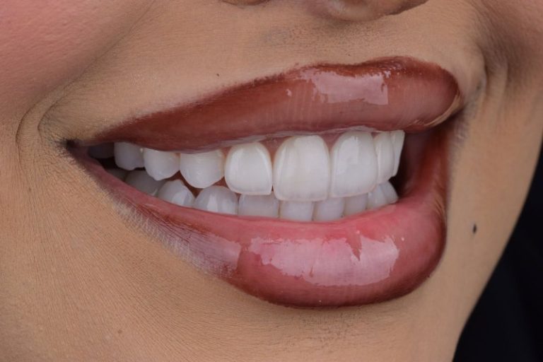 Common Cosmetic Dental Problems and the Best Treatment for Each